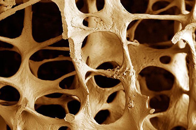 High-dose, long-term effects of corticosteroids include brittle bones that break easily (osteoporosis), slow growth in kids, adrenal insufficiency, muscle weakness, eye problems (including cataracts), and a higher risk of diabetes.