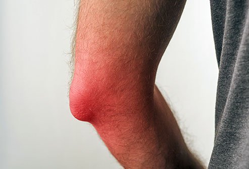 The best way to treat bursitis is to let the inflamed joint or limb rest, or you could prevent it from healing. Rest your body and avoid heavy activity, apply ice, alternate with a heating pad or warm compress, take over-the-counter (OTC) pain relievers, avoid tobacco smoke as it delays tissue and wound healing.