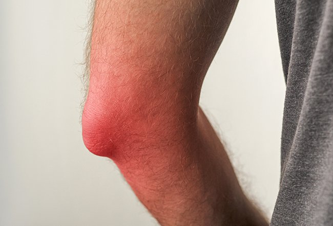 Tennis elbow symptoms