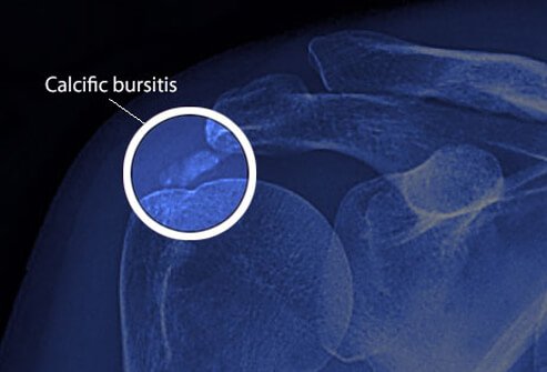 Calcific bursitis refers to calcium deposits that build up in a bursa and cause pain and inflammation.