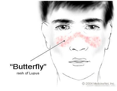 Picture of systemic lupus erythematosus (SLE or lupus) butterfly rash