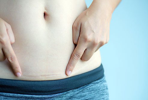 Picture of a woman with her hands by her C-section delivery.