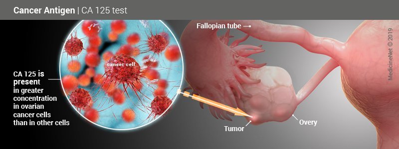 CA 125 is elevated in ovarian cancer as well as in some benign conditions.