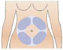 Clean your injection site with an alcohol swab - Illustration