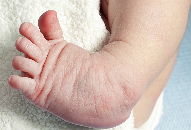 Clubfoot is a common congenital foot deformity. Clubfoot can be fixed with the Ponseti method of stretching and casting and with surgery.