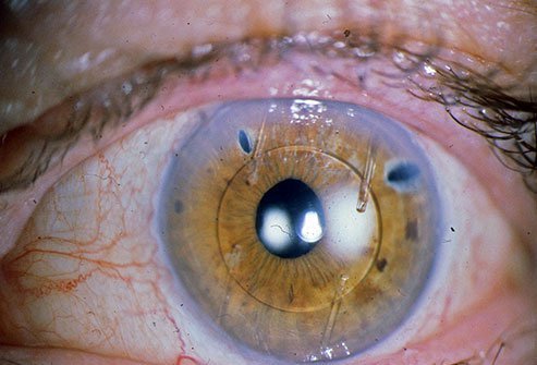 Yes, an intraocular lens (IOL) can be removed and replaced