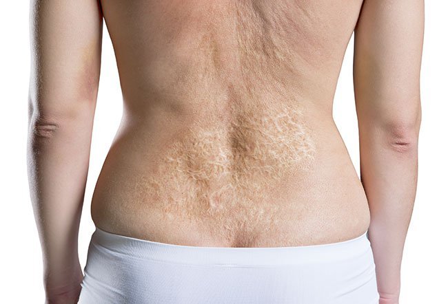 burn scars