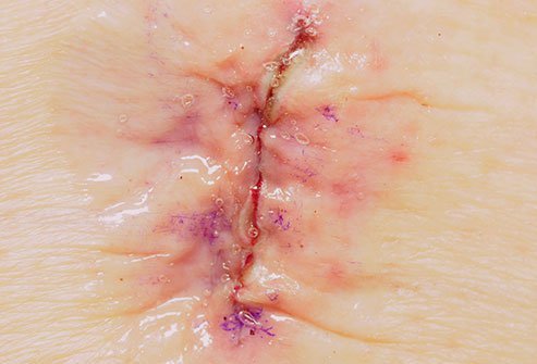 Dermabond may be used to close small wounds. 