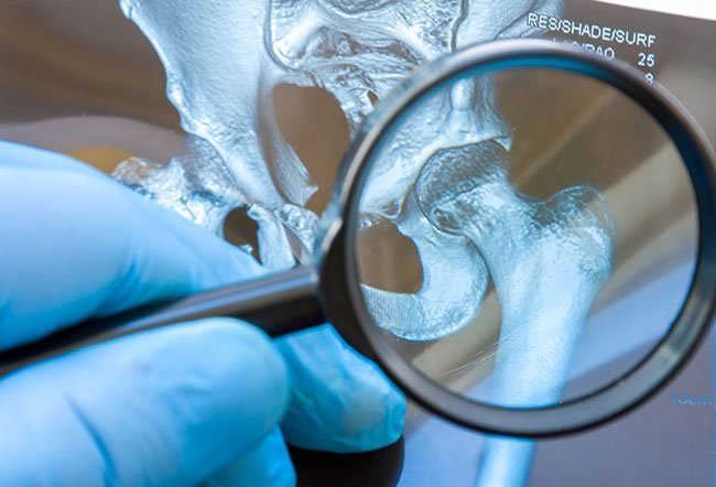 Hip dysplasia often needs surgical correction.