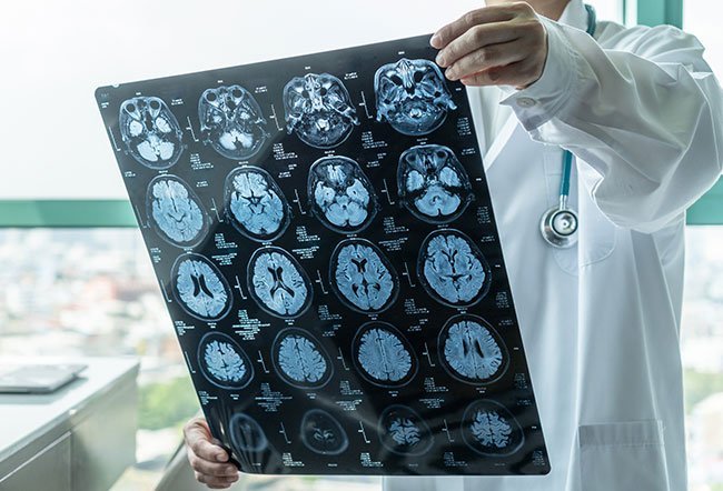 Brain damage may be caused by ruptured or blocked blood vessels or a lack of oxygen and nutrient delivery to a part of the brain. Brain damage cannot be healed, but treatments may help prevent further damage and encourage neuroplasticity. 