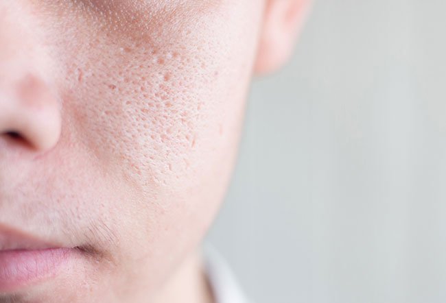 Pore size is genetically determined, so you can't actually shrink pores. You can use pore-minimizing products, cooling treatments and products containing vitamin B3, niacinamide, picolinamide, zinc oxide and collagen to attempt to minimize the appearance of pores.