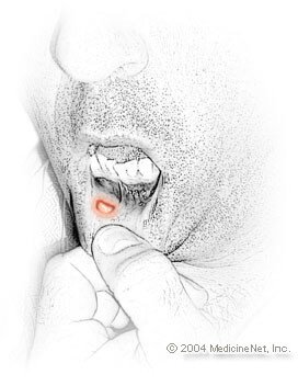 Picture of a canker sore