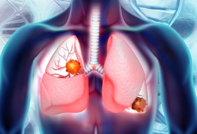 A tumor is a mass or lump of tissue in an organ.