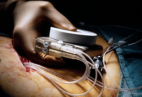 Cardiac resynchronization therapy involves inserting electrodes into the heart attached to an electrical pacemaker device, which will administer electrical current when the heartbeat falls out of rhythm.
