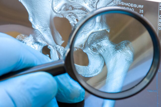 As you age, your knees and other joints can get osteoarthritis.