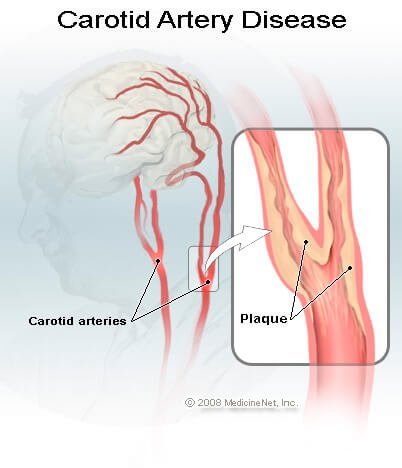 Carotid Artery Disease