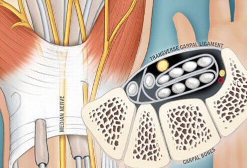 If the median nerve is compressed or pinched, it leads to carpal tunnel syndrome symptoms.