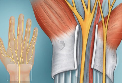 The ligament overlying the top of the carpal tunnel is cut to relieve pressure.