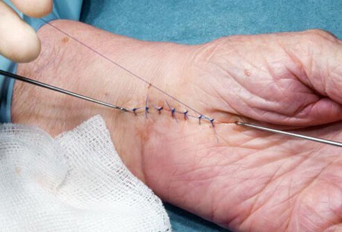 Carpal tunnel surgery relieves symptoms but recovery may take up to six months to one year. 