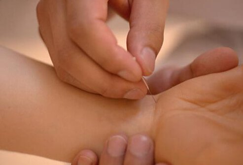 Acupuncture helps nerves function better and may help relieve carpal tunnel symptoms.