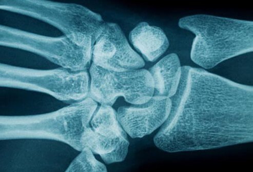Any number of conditions or injuries that cause swelling or inflammation in the area may lead to compression of the median nerve.