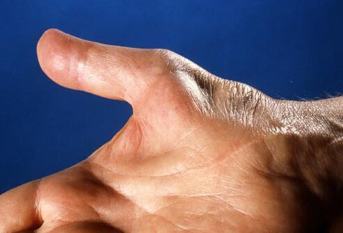 If it is untreated, carpal tunnel syndrome symptoms may wax and wane.
