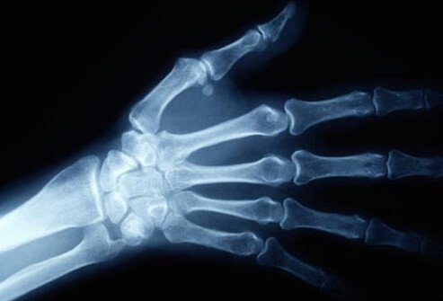 Pain, numbness, tingling, weakness, and muscle atrophy can be due to symptoms other than carpal tunnel syndrome.