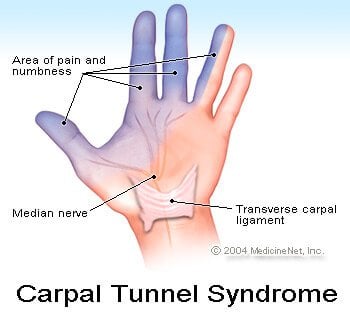 Picture of carpal tunnel syndrome