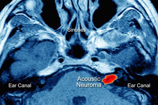 Sometimes a slow-growing, benign tumor develops around the nerves that control balance and hearing.