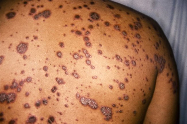Psoriasis causes discolored patches of skin, mostly on the knees and scalp.