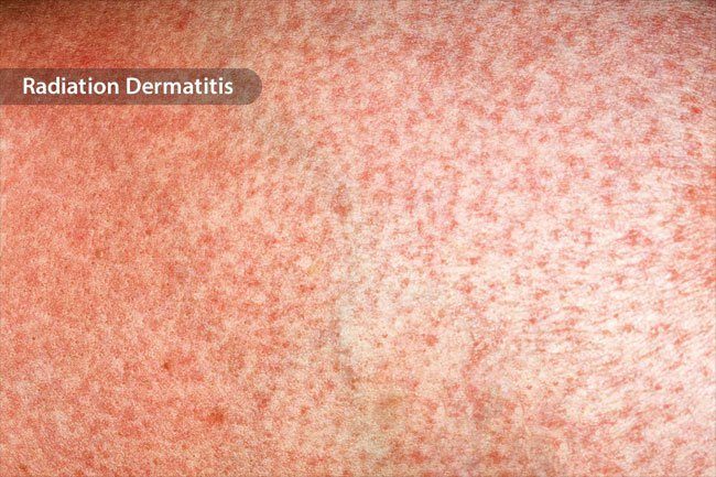 You may get skin discoloration after surgery, chemotherapy or radiation.