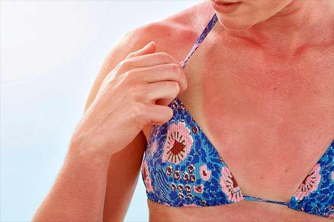 Sunburn makes your skin red and it may lead to skin aging over time.