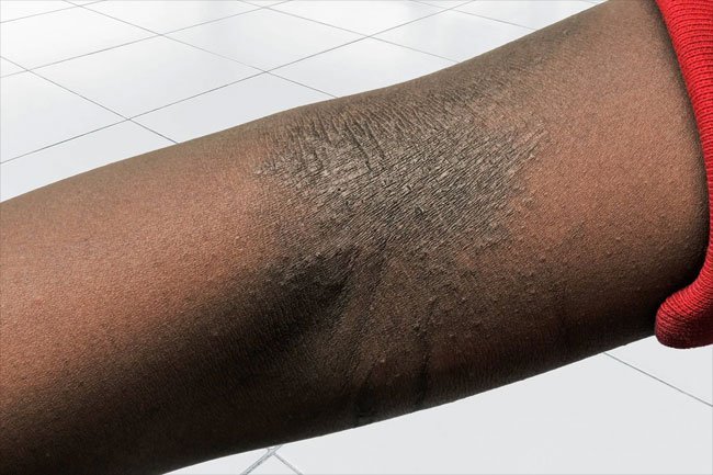 Eczema causes dry, itchy patches of skin that may be red, brown, purple or gray.