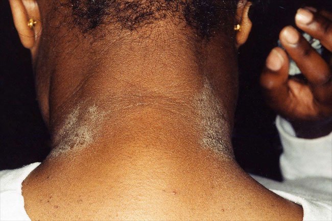 Topical steroids may help treat skin lesions due to eczema or atopic dermatitis.