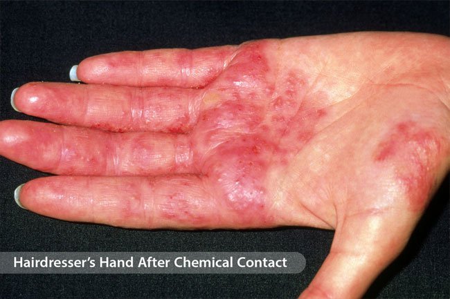 Makeup, hair dye, metals, soaps, dyes and plants may trigger contact dermatitis.