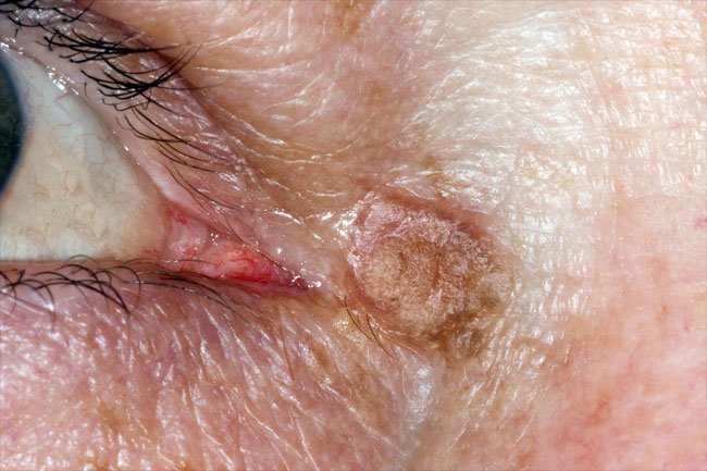 Actinic keratosis are skin lesions that appear due to the sun and they may be precancerous.