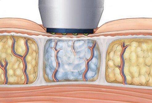 Devices that produce heat and project radio waves into the dermis (a layer of skin), presumably destroying fat cells, are very popular.