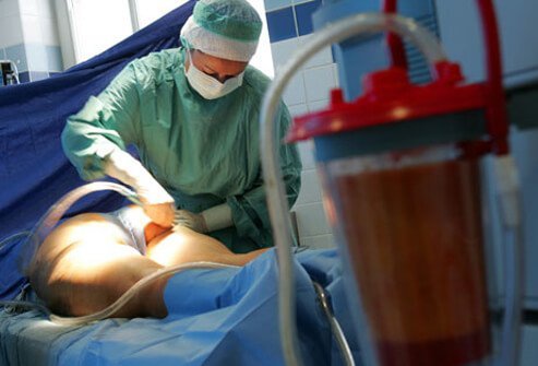 It may occasionally even worsen the appearance of cellulite.
