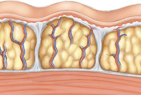 New noninvasive imaging along with digital 3-D technologies helped show how cellulite is caused by fat deposits that sit in between collagen fibers.