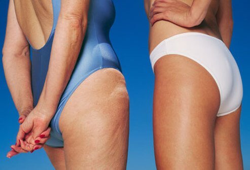 Cellulite is the term given to the dimpled skin on the abdomen, buttocks, and thighs of most healthy adult women.