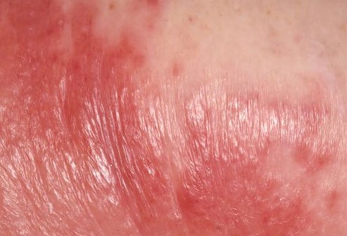 Cellulitis is an infection that occurs when bacteria enter the skin and causes a dimpled appearance due to the presence of fatty deposits.