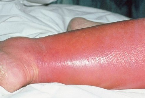 Cellulitis most often affects the lower leg.