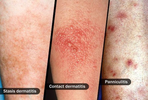 Cellulitis symptoms mimic those of other conditions so get an examination by an experienced doctor.