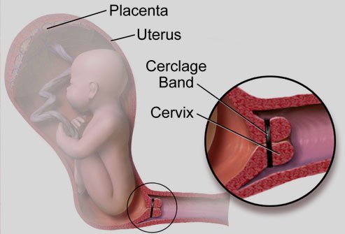 Cervical cerclage is a procedure in which the doctor puts a single stitch around the cervix to close it.