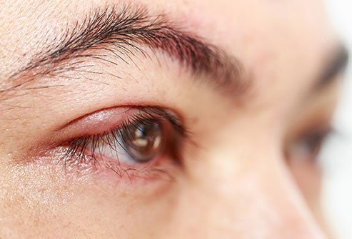 The two types of stye are hordeolum and chalazion. 