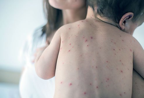 The difference between chickenpox and shingles is that the first time you get infected with the varicella virus, you get chickenpox. Shingles is a condition you can develop if you've already had chickenpox.