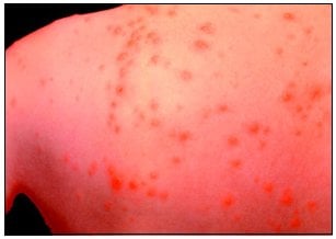 Chickenpox Photo - Chickenpox Rash