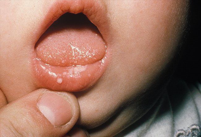 what triggers oral lichen planus