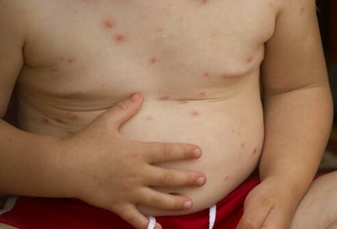 The varicella virus causes chickenpox.