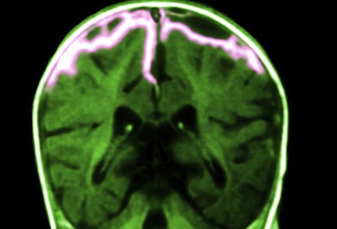 Meningitis is an inflammation of the tissue surrounding the brain and spinal cord (meninges).